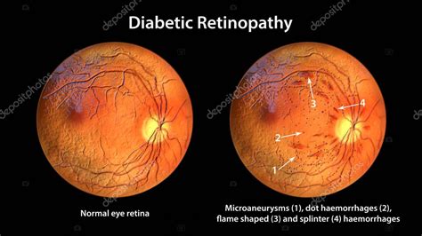 Ilustración: Retina con hemorragias y lesiones por retinopatía diabética