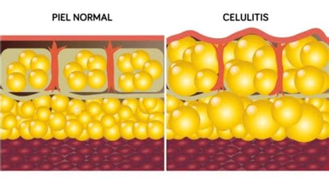 Gráfico que ilustra la diferencia entre piel con celulitis, flacidez y grasa localizada