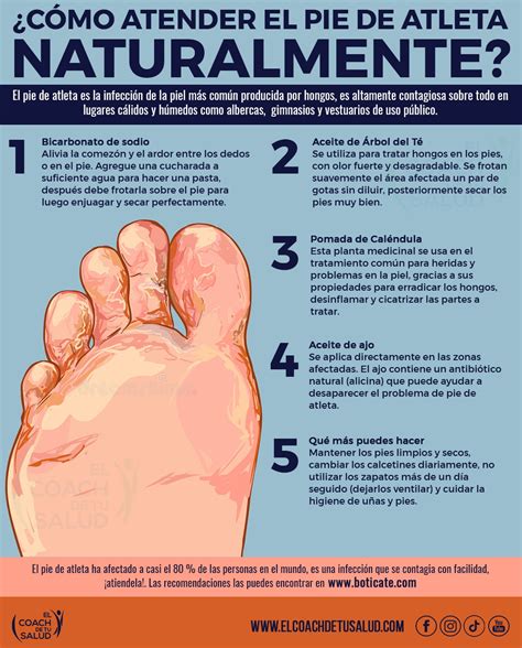 Infografía comparativa de los diferentes tipos de pie de atleta: interdigital, escamosa y vesiculosa, con sus síntomas característicos.