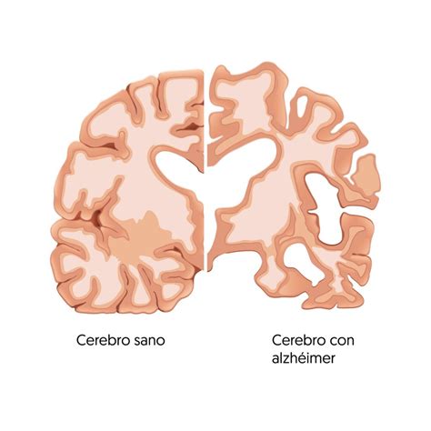 Esquema: Comparativa de un cerebro sano y un cerebro afectado por Alzheimer