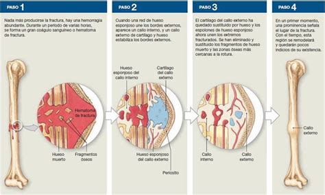 Esquema de las etapas de recuperación tras una fractura de cadera
