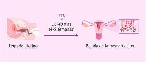 Diagrama ilustrando los pasos del legrado uterino: dilatación cervical y curetaje.