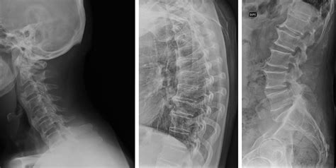 Radiografía de columna vertebral mostrando osificaciones ligamentosas típicas de la enfermedad de Forestier