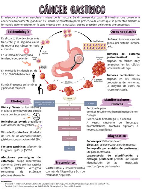 Infografía: Tipos de cáncer gástrico (adenocarcinoma, GIST, carcinoides, linfoma)