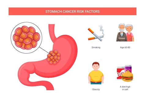 Infografía: Factores de riesgo del cáncer de estómago (H. pylori, dieta, tabaquismo, reflujo)
