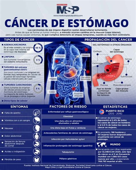 Infografía: Síntomas comunes del cáncer de estómago