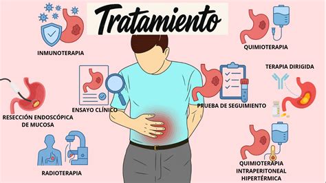 Infografía: Opciones de tratamiento para el cáncer gástrico (cirugía, quimioterapia, radioterapia, terapias dirigidas)