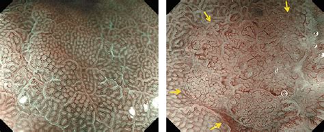 Imágenes médicas: Endoscopia, TAC y histopatología de cáncer gástrico incipiente