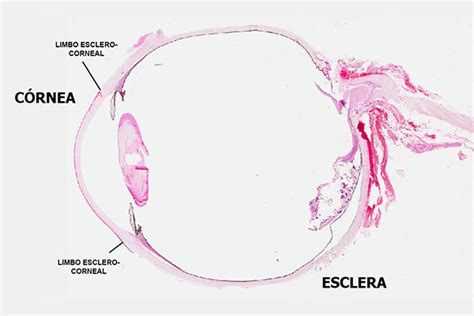 Esquema de la córnea con las zonas afectadas por la degeneración marginal pelúcida