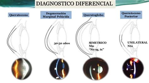 Ejemplos de mapas topográficos de córneas con queratocono vs degeneración marginal pelúcida