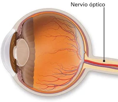 Esquema del ojo humano mostrando el nervio óptico afectado por glaucoma