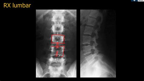 Radiografía de una hernia discal