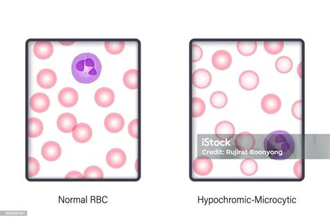 Esquema de las diferencias morfológicas entre glóbulos rojos normales, microcíticos e hipocrómicos