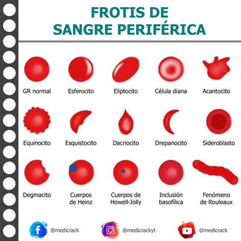Imagen de un frotis de sangre periférica con células microcíticas e hipocrómicas