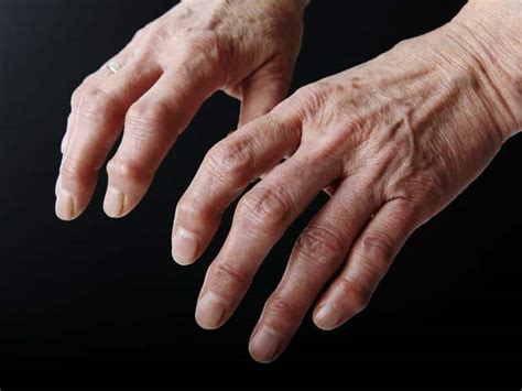 Manos de anciana con artrosis, que muestran venas transparentes y piel como corteza
