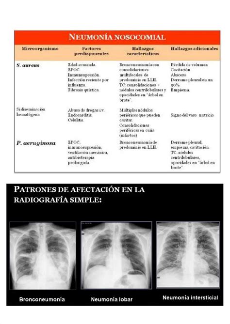 esquema comparativo de neumonía unilateral, bilateral y bronconeumonía en radiografías de tórax