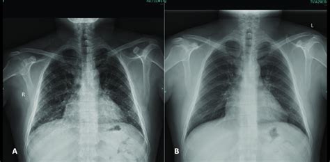 ejemplo de radiografía de tórax con infiltrados pulmonares por neumonía