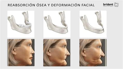 Infografía ilustrando la resorción ósea facial y el impacto en la mandíbula y pómulos
