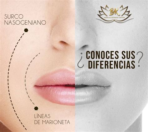 Ilustración de un rostro Dólico Óseo-Facial con surcos nasogenianos marcados