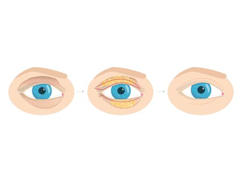 Ilustración de un rostro Meso Óseo-Facial Activo con hinchazón en los párpados