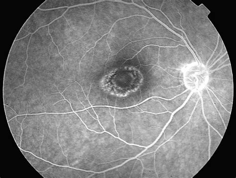 Imagen de una retina con maculopatía en ojo de buey