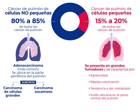 Infografía comparativa de los tipos de cáncer de pulmón (células pequeñas vs. no pequeñas)