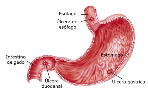 Ilustración detallada de la anatomía de una úlcera maligna y su tratamiento.
