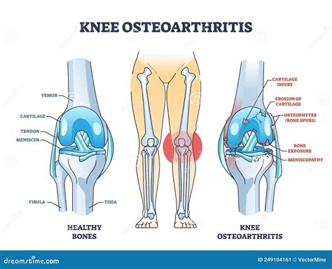 Esquema detallado de una exo-rodillera ortopédica para osteoartritis con puntos clave