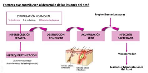 Esquema sobre la fisiopatología del acné adulto: influencia de hormonas, medicamentos y factores ambientales.