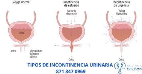 Diagrama de los diferentes tipos de incontinencia urinaria