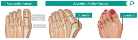 Diagrama de pie mostrando la formación de un juanete