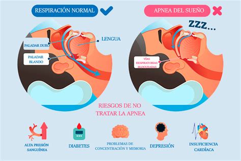 Esquema de la interconexión entre apnea del sueño y riesgo de ACV