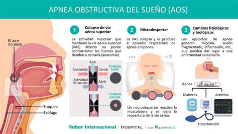 Diagrama de los mecanismos fisiopatológicos de la apnea del sueño que conducen al ACV