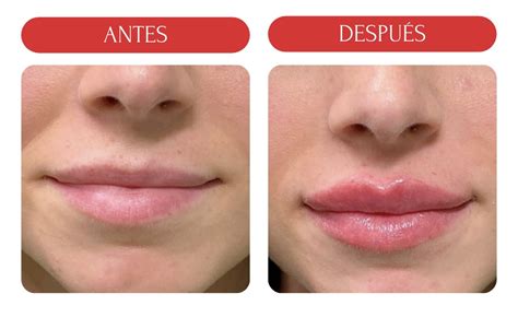 Infografía comparativa de los efectos del ácido hialurónico en los labios antes y después.