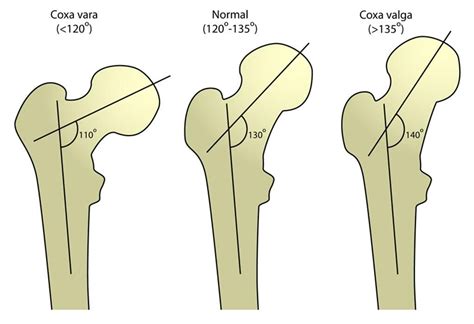 Radiografía prequirúrgica y postquirúrgica (al año y a los 3 años) de coxa vara congénita para comparación