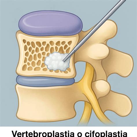 Representación esquemática de los procedimientos de vertebroplastia y cifoplastia.