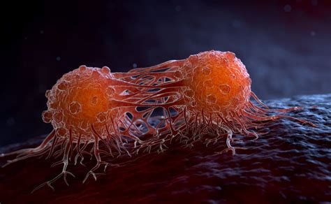 Esquema de las metástasis óseas en el cuerpo humano, mostrando las localizaciones más comunes.