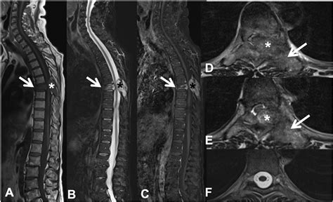 Imagen de una resonancia magnética de columna vertebral mostrando metástasis óseas con compresión medular.