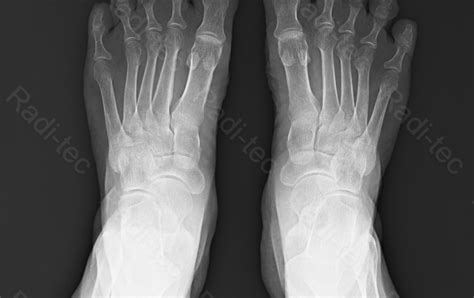 Radiografía de pie normal en proyecciones anteroposterior y oblicua (Figura 77)