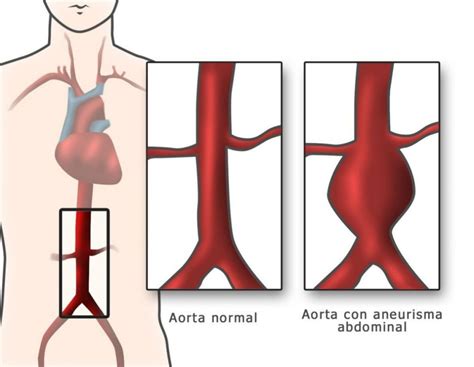 Representación gráfica de la aorta abdominal con un aneurisma