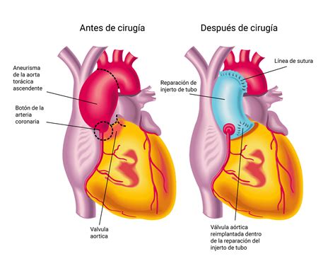 Diagrama comparativo de la cirugía abierta y la reparación endovascular de un aneurisma aórtico abdominal