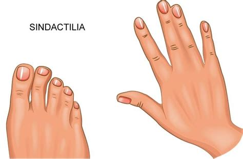 Fotografía de una mano con sindactilia asociada al síndrome de Poland