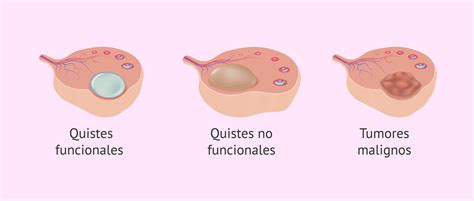 Esquema de un ovario con quistes funcionales y folículos
