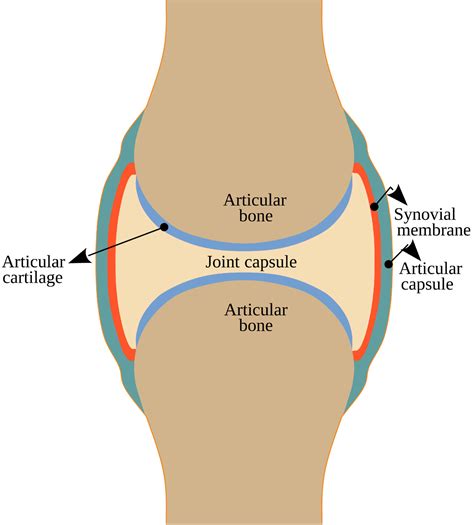 Esquema visual comparando una articulación sana con una afectada por artrosis, mostrando el desgaste del cartílago