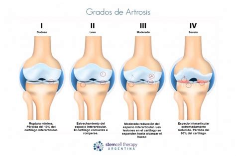 Diagrama que ilustra los diferentes tipos de complicaciones de la artrosis en las articulaciones