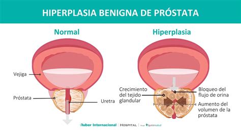 Diagrama que ilustra cómo el crecimiento de la zona transicional de la próstata comprime la uretra.