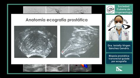 Infografía comparativa de los resultados de una biopsia transrectal guiada por ecografía y una biopsia por fusión RMN-ECO.