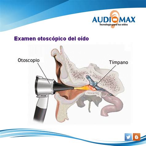 Ilustración de un examen otoscópico mostrando la inserción del otoscopio en el oído.
