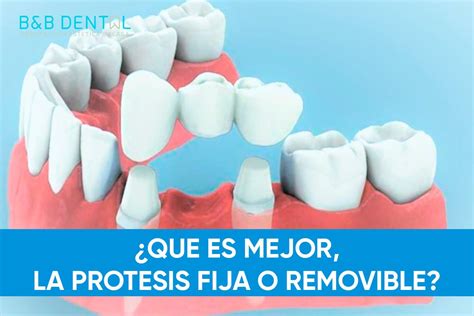 Infografía ilustrando los tipos de prótesis dentales: fija, removible y sobre implantes