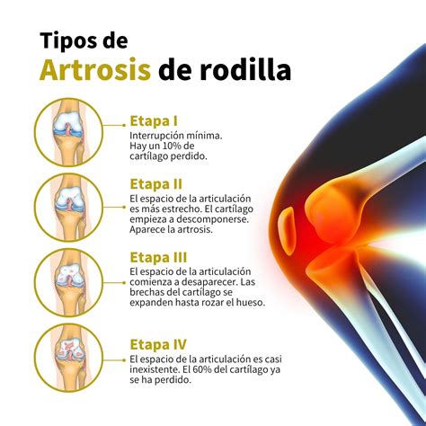 Ilustración de una rodilla afectada por artrosis, mostrando la degeneración del cartílago.